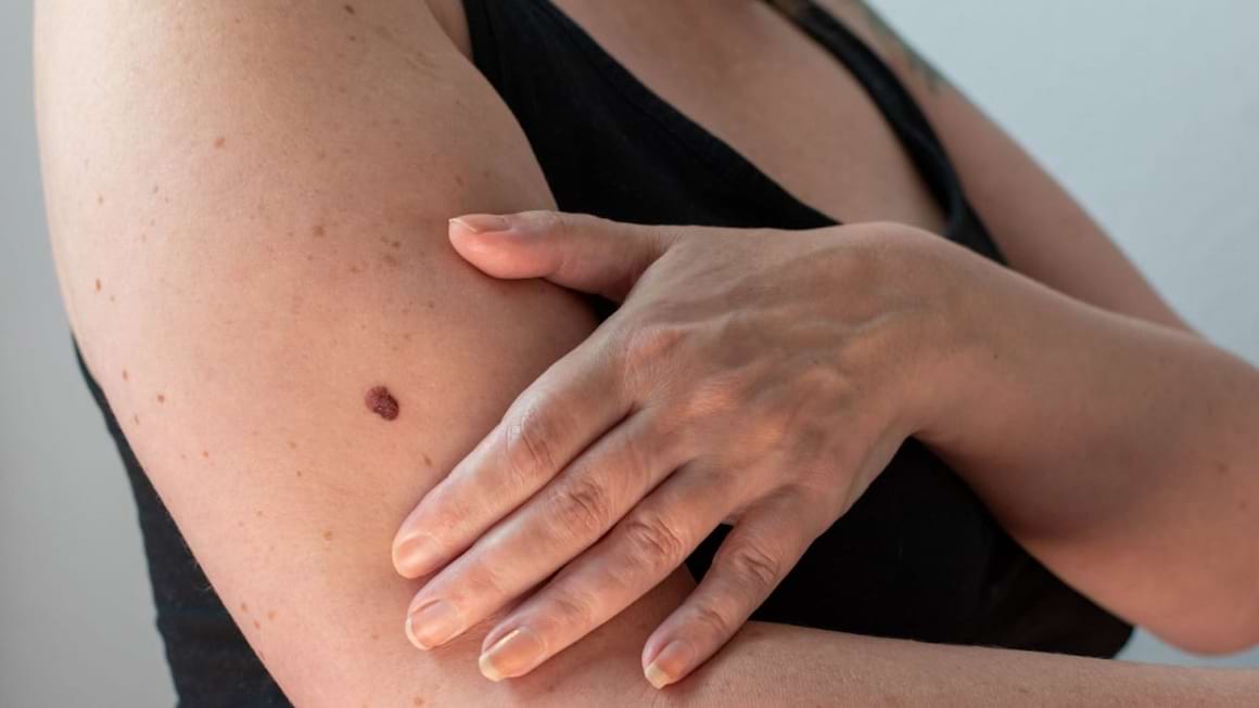 5 lucruri esentiale pe care trebuie sa le stii despre melanom