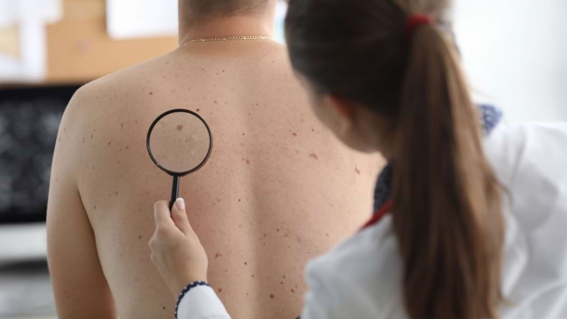 Ce medici depisteaza si trateaza cancerul de piele?