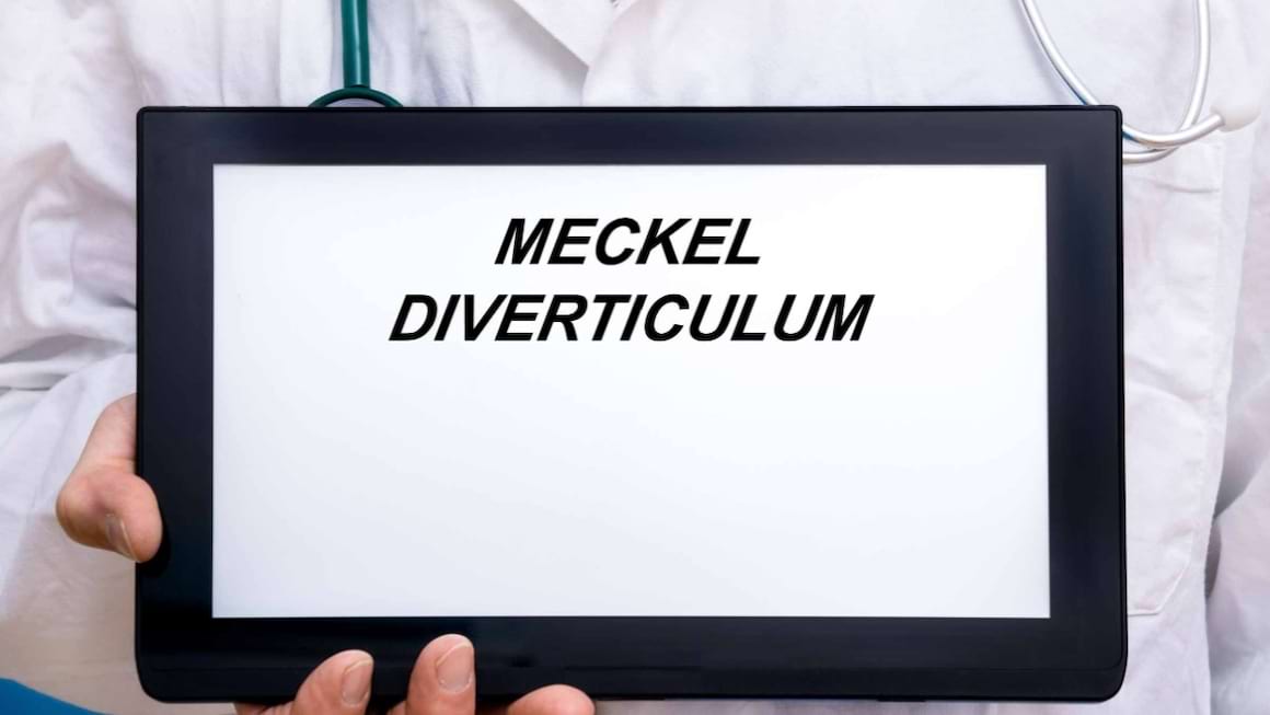 Diverticul Meckel: simptome, cauze, diagnostic și tratament
