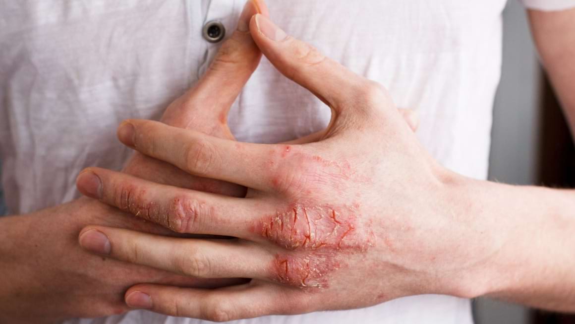 Pericolul infecțiilor în dermatita atopică