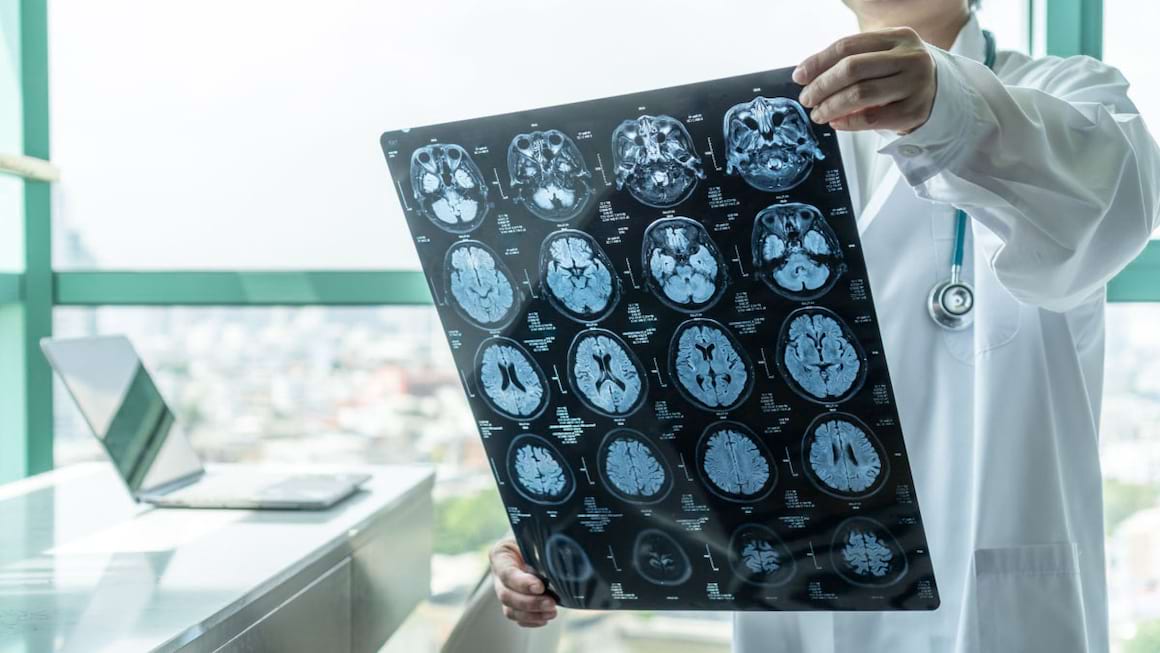 Ce trebuie sa stii despre accidentul vascular cerebral (AVC)?