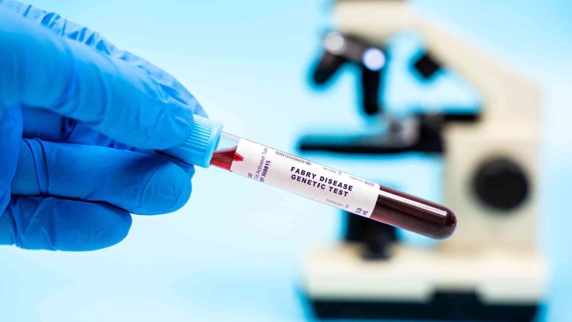 Boala Fabry: simptome, diagnostic și tratament