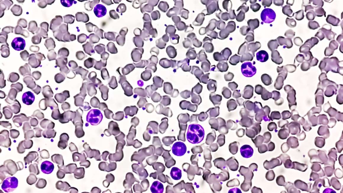 Totul despre leucemia granulocitară (leucemie mieloidă cronică)