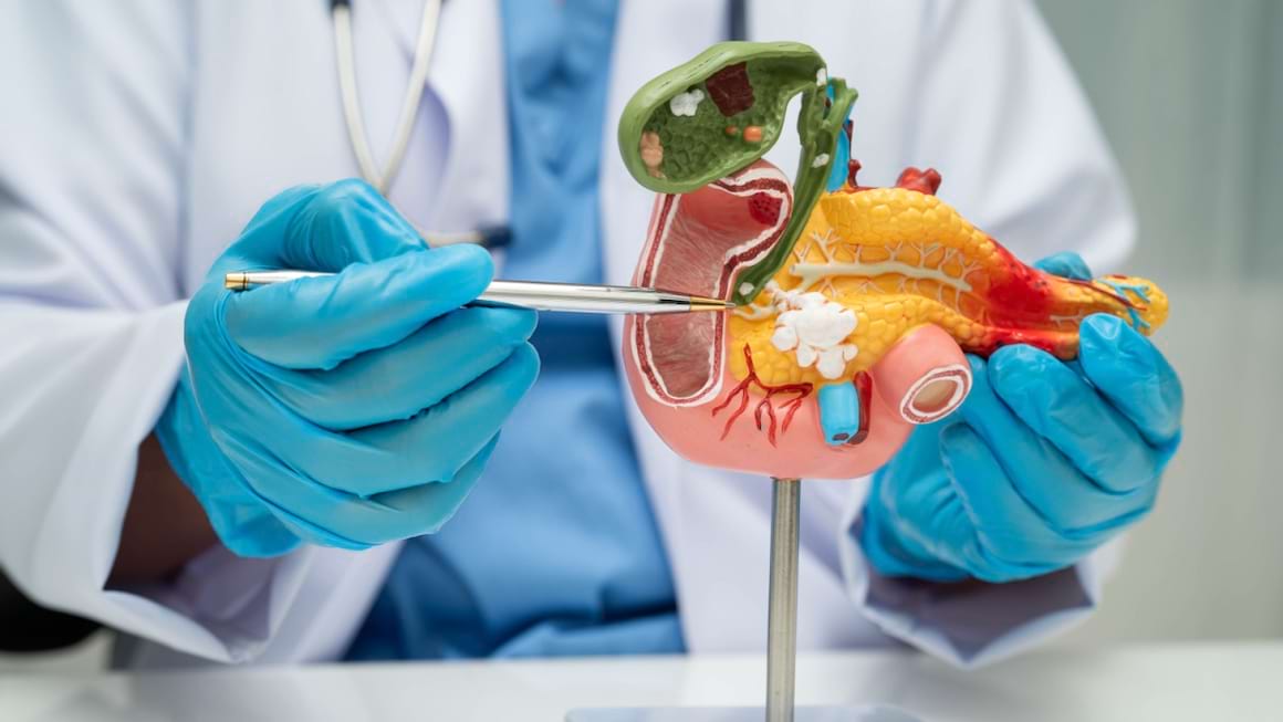 Tratamentul in cancerul de pancreas avansat