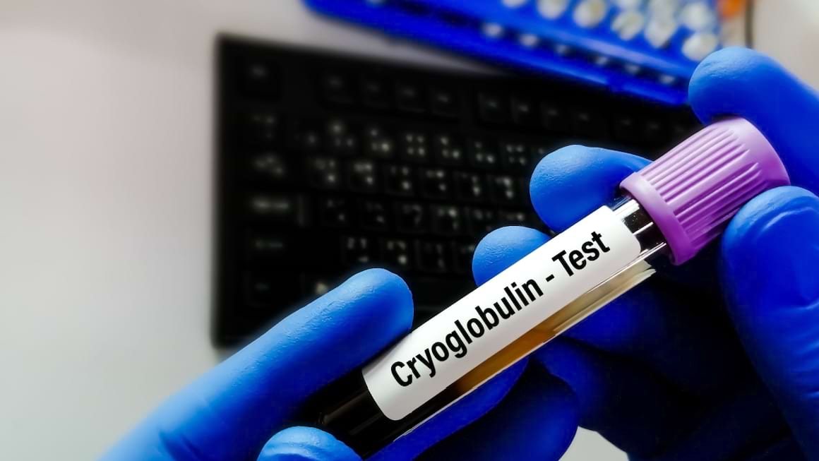 Crioglobulinemia: cauze, manifestări, tratament