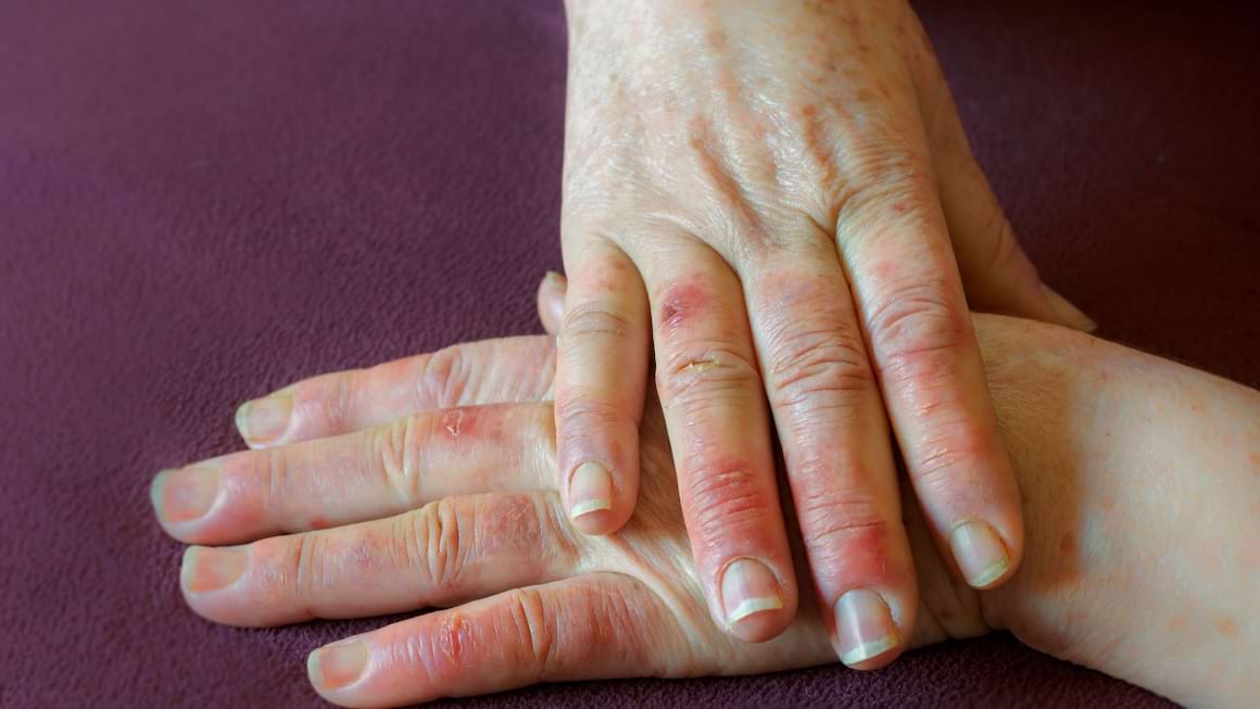 Recomandări pentru pacienții cu fenomen Raynaud