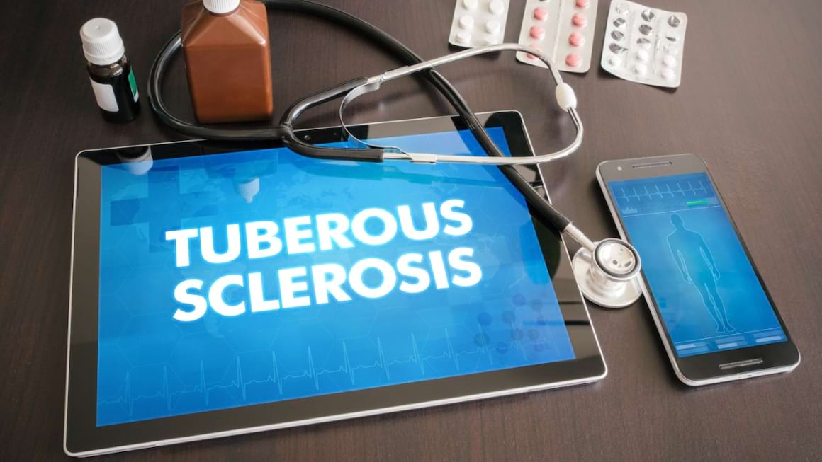 Scleroza tuberoasă: cauze, manifestări, tratament