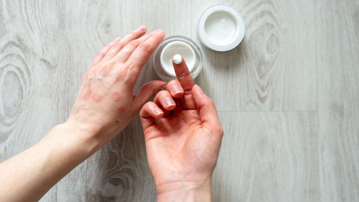 10 remedii naturale pentru psoriazis