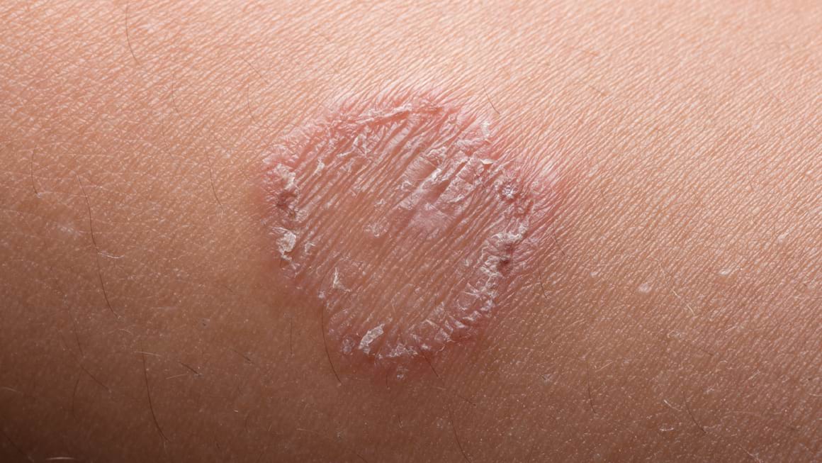 Pecingine: cauze, simptome, diagnostic și tratament
