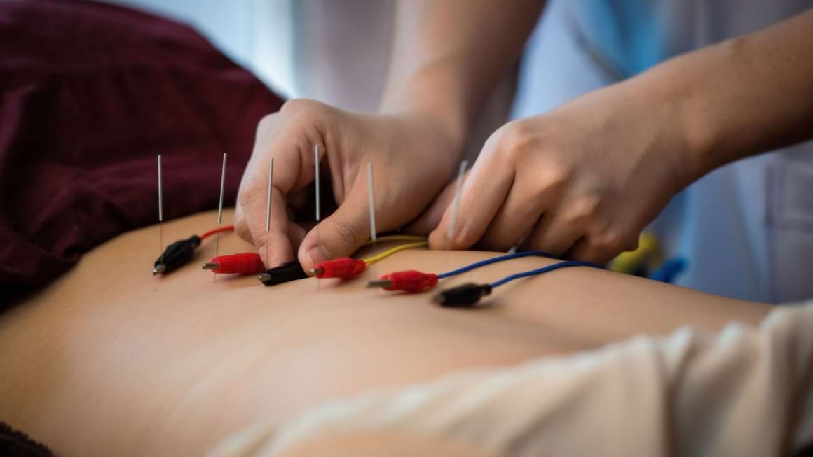 Electroacupunctura: ce este și când se recomandă?