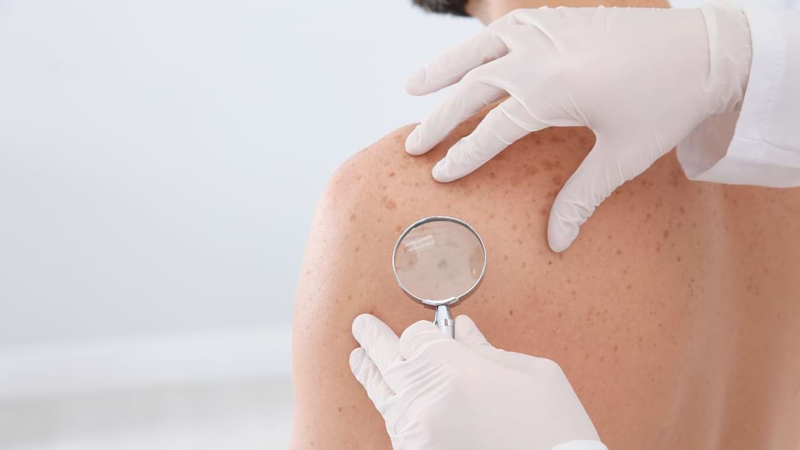 8 simptome ale cancerului de piele pe care le ignori