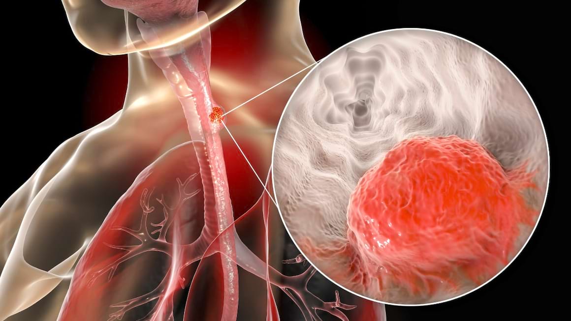 Cancerul esofagian, locul sase in lume in topul mortalitatii prin cancer