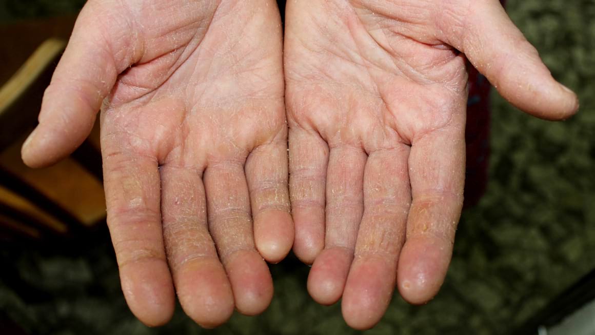 Keratoza palmo-plantara – cauze si tratament