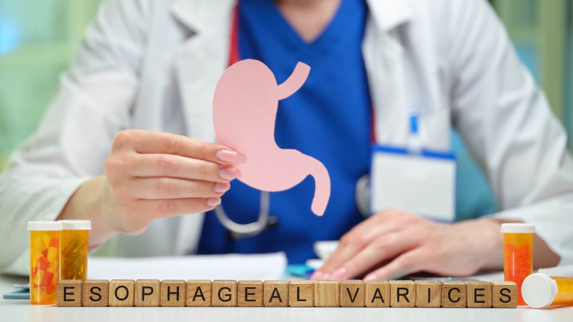 Varicele esofagiene, frecvente la pacientii cu probleme hepatice
