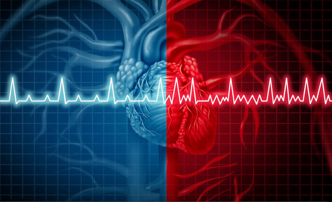 Fibrilația atrială - cauze, simptome, tratament