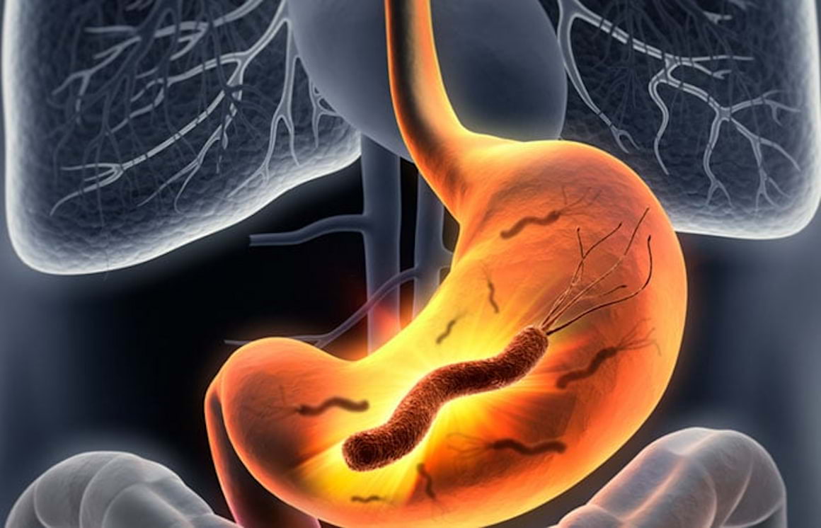 Helicobacter Pylori - Cauze, Simptome & Tratament