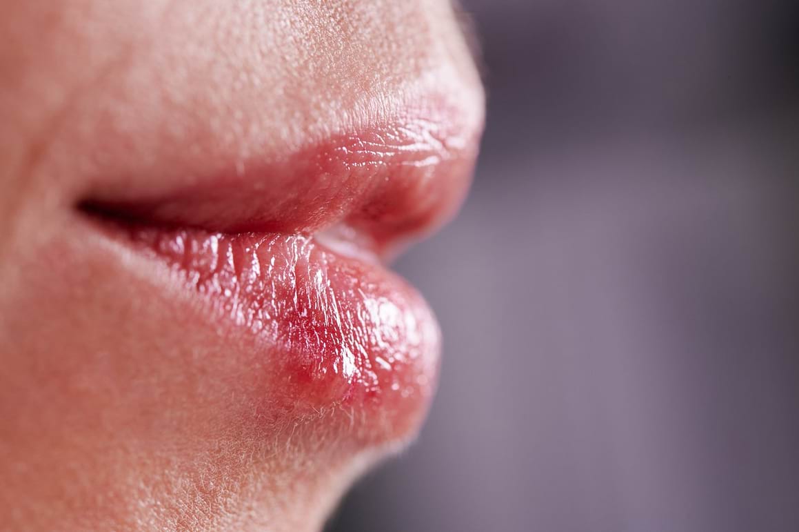 Herpesul și sexul oral: care sunt riscurile la femei? (studiu)