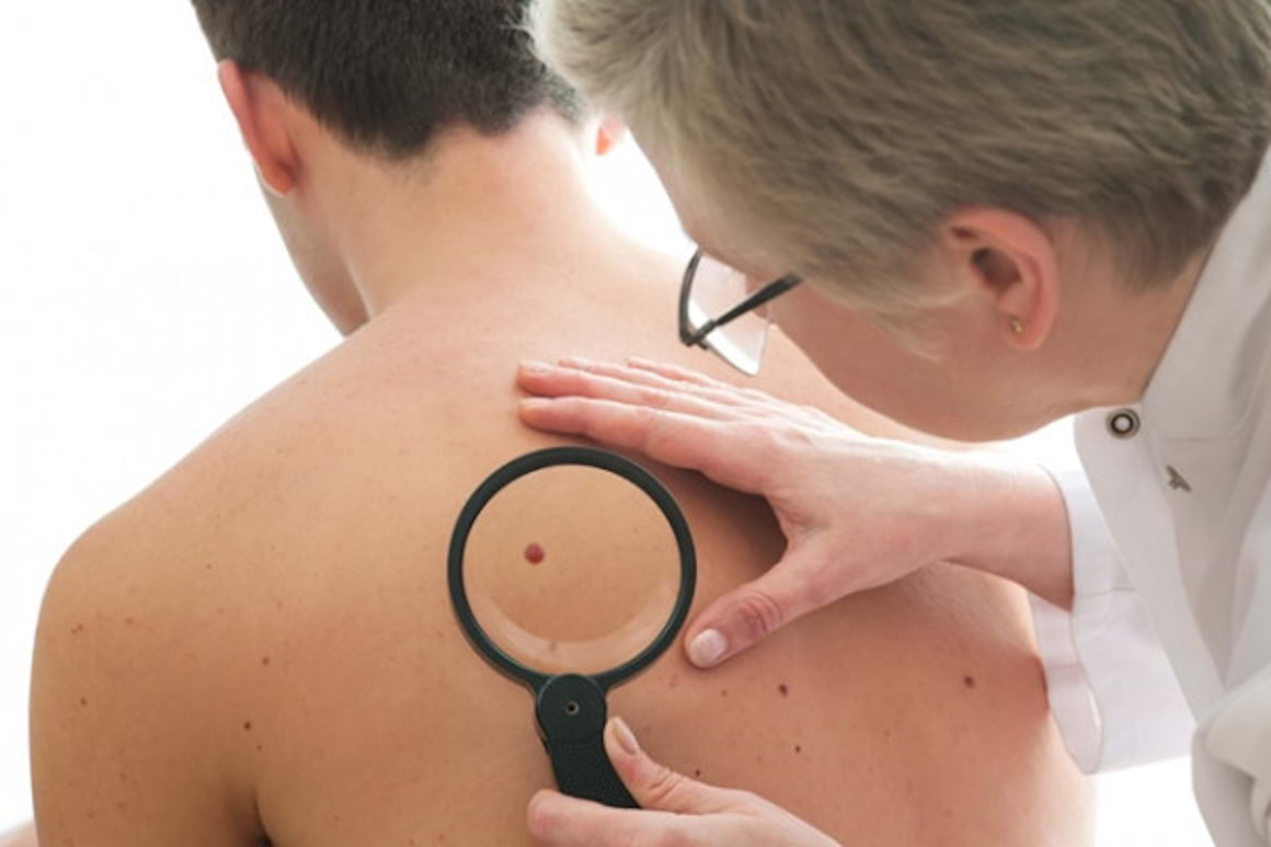 Barbatii, mai expusi melanomului decat femeile