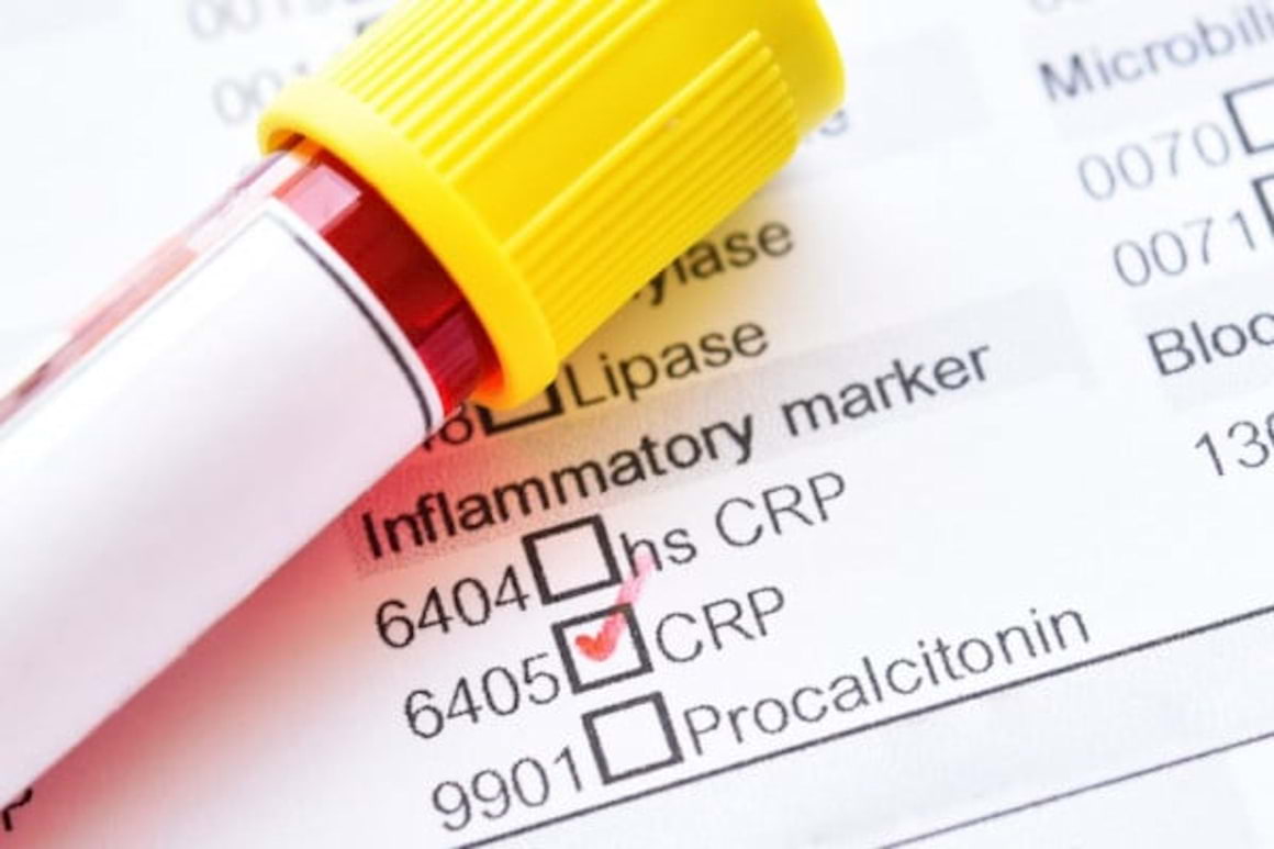 Biomarkerii pot arata daca injectiile cu steroizi functioneaza la pacientul cu dureri lombare