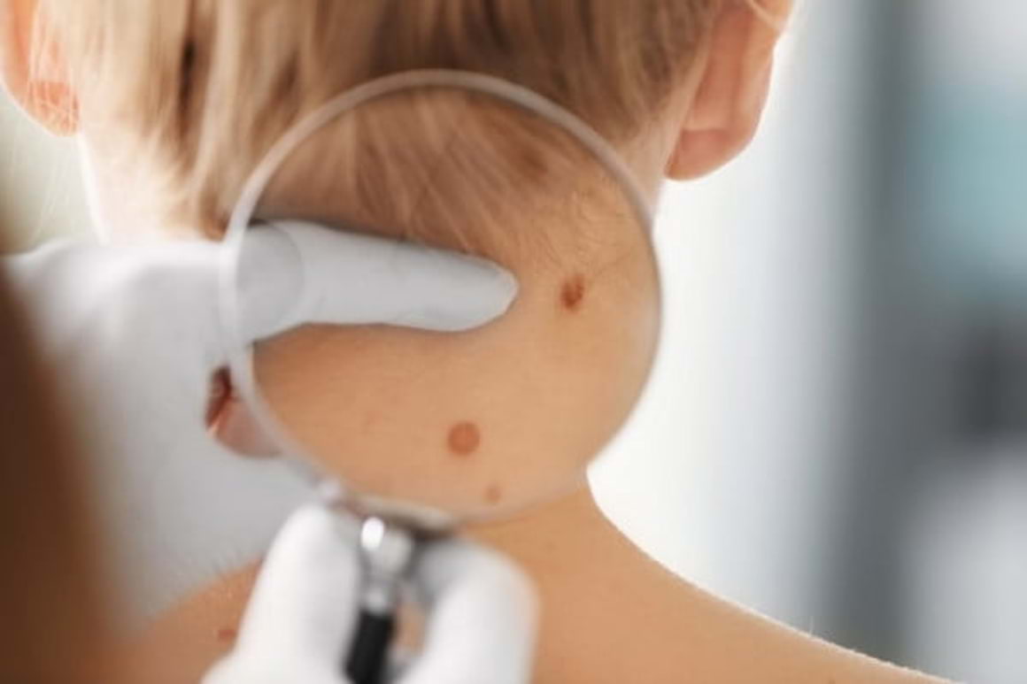 Biopsia in cancerul de piele - ce rol are si cum se face