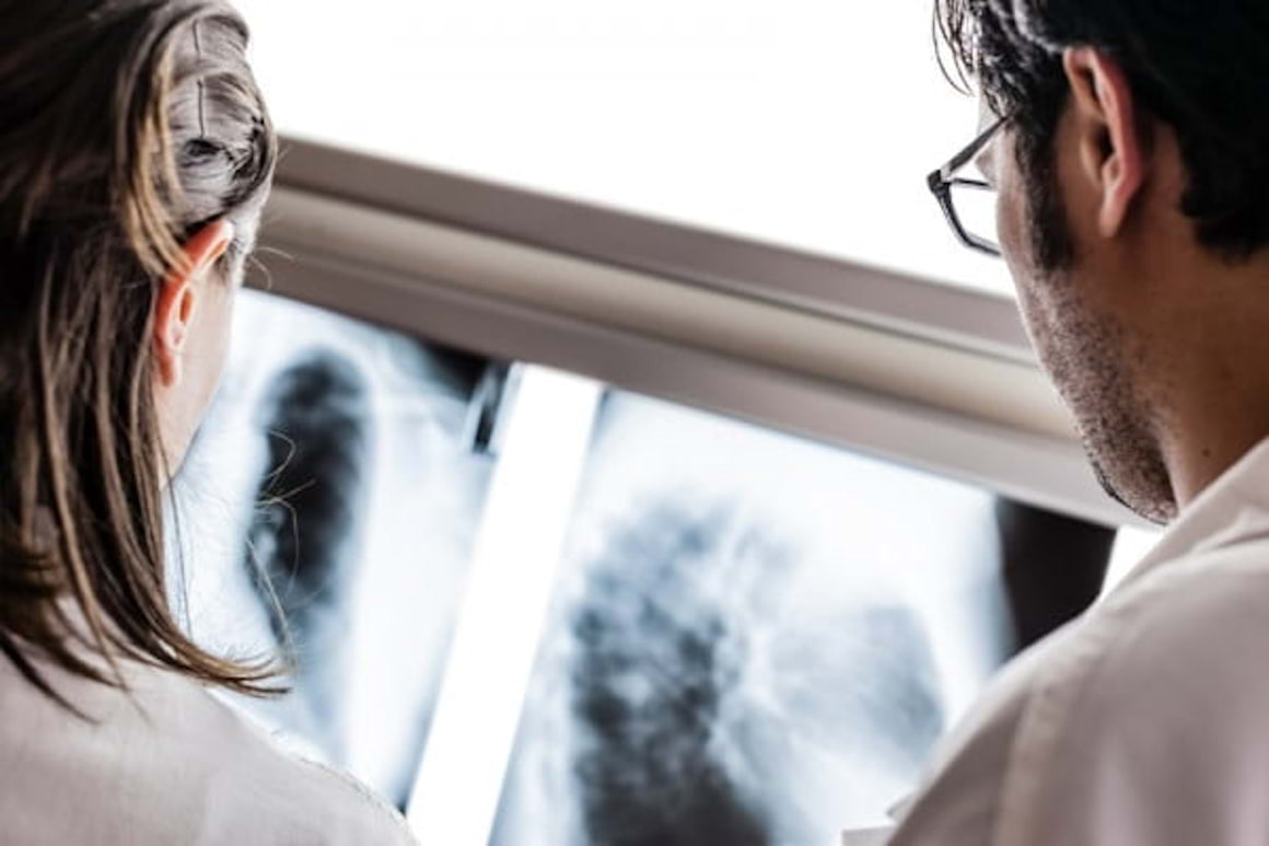 Cancerul pulmonar metastatic – cum apare si cum poate fi gestionat diagnosticul