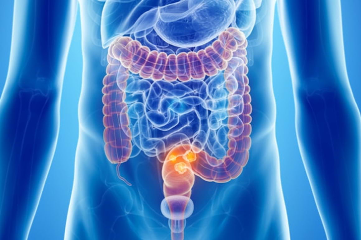 Cancerul colorectal metastatic intre consens si controverse