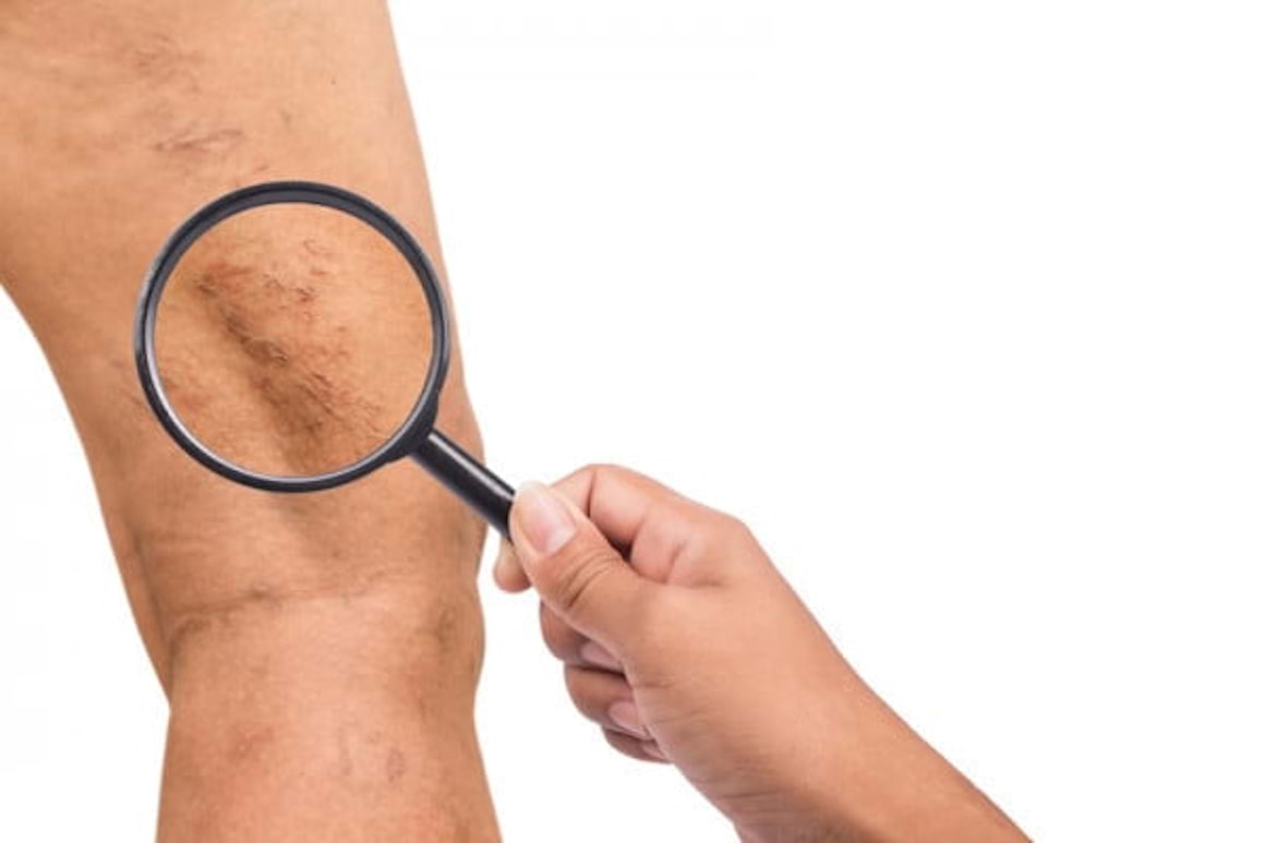 Ciorapii medicinali de compresie: cum ajuta in cazul insuficientei venoase