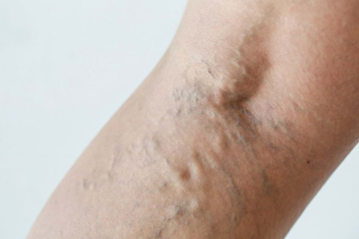 Clasificarea clinica a insuficientei venoase cronice