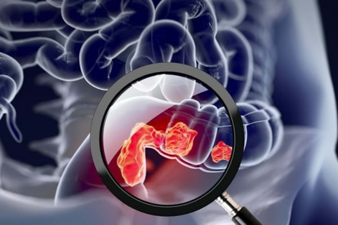 Cercetatorii au descoperit mecanismul prin care colita cauzeaza cancer colorectal
