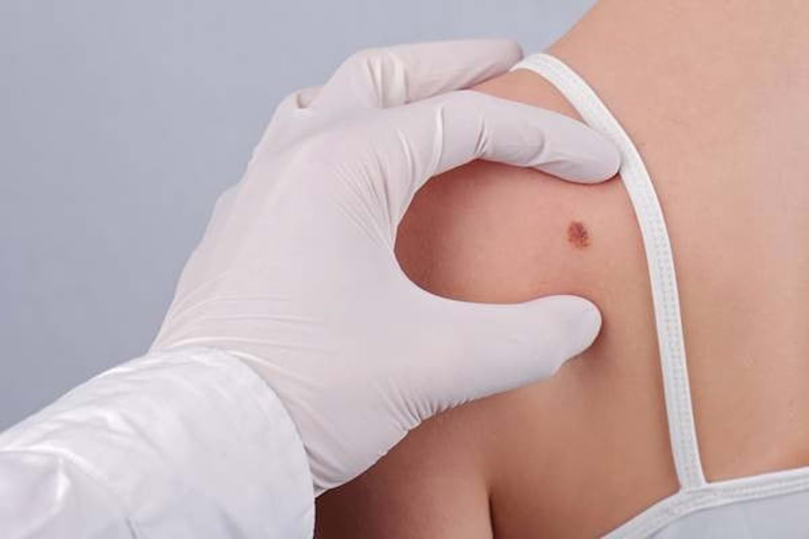 Melanomul cutanat, o tumora frecventa