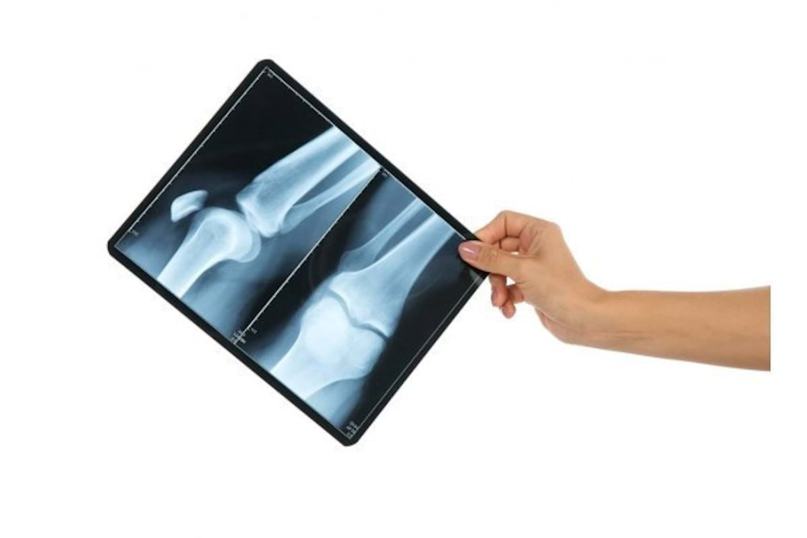 Fenotipuri de progresie radiologica in cazul pacientilor cu gonartroza precoce