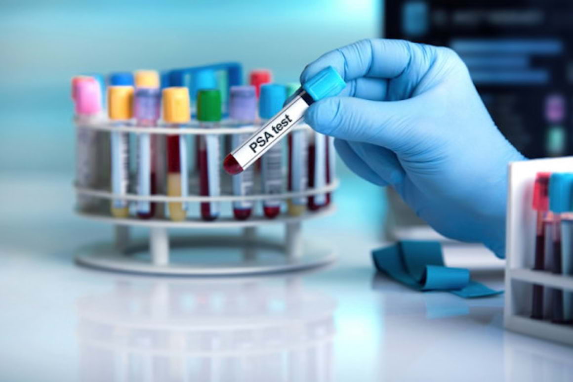 Recidiva biochimica in cancerul prostatic