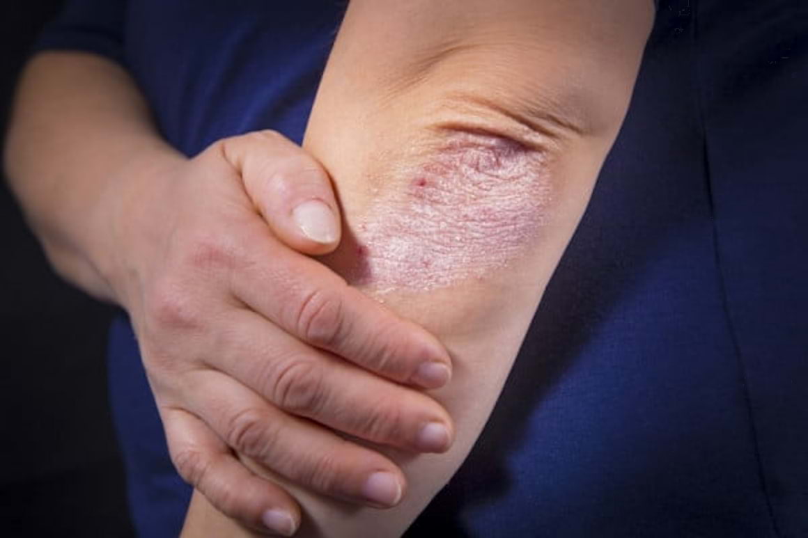Dieta în psoriazis: cum reduci inflamația din organism?