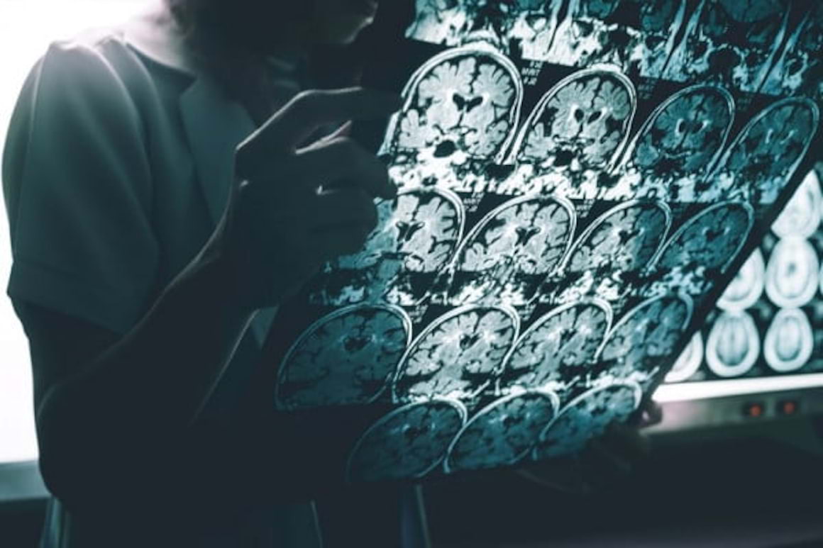 Scleroza laterala amiotrofica: cauze, simptome si tratament
