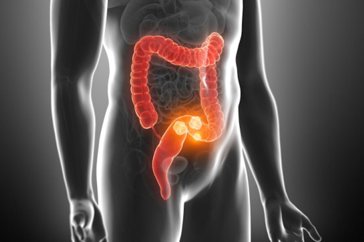 Necesitatea screening-ului cancerului colorectal, boala care ucide aproape 10.000 de romani anual