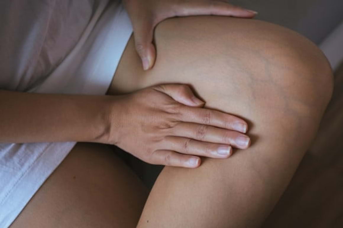 Semnele si simptomele insuficientei venoase cronice