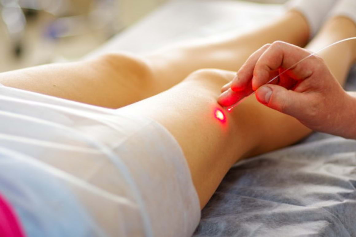 Varice: Cum ajuta tratamentul cu laser endovenos in cazul venelor inestetice