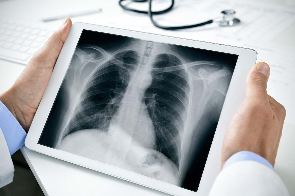 Leziunile pulmonare cauzate de țigările electronice seamănă cu arsurile chimice [studiu]