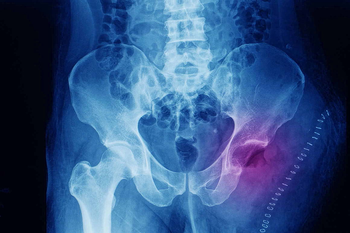 Osteosarcomul la copii, asociat cu defecte ale genelor? [studiu]