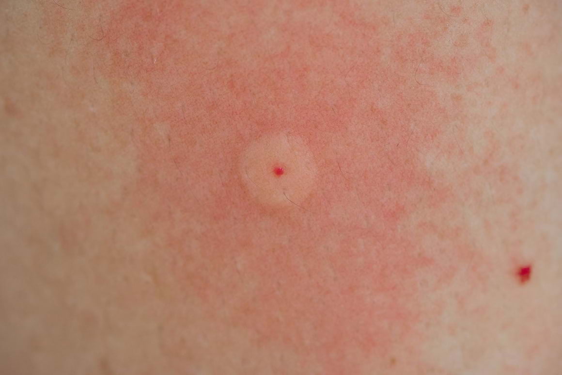 Alergia la veninul de albină și viespe - ce trebuie să știi