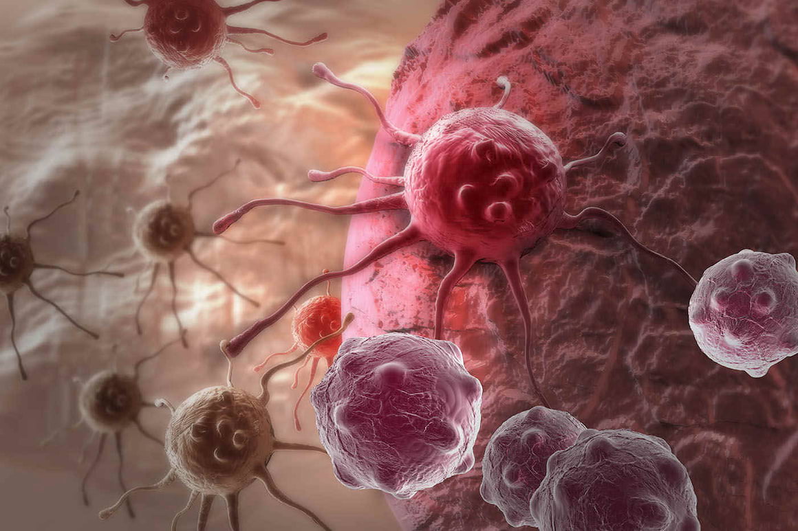 Cancerul: formele lui și metodele de tratament