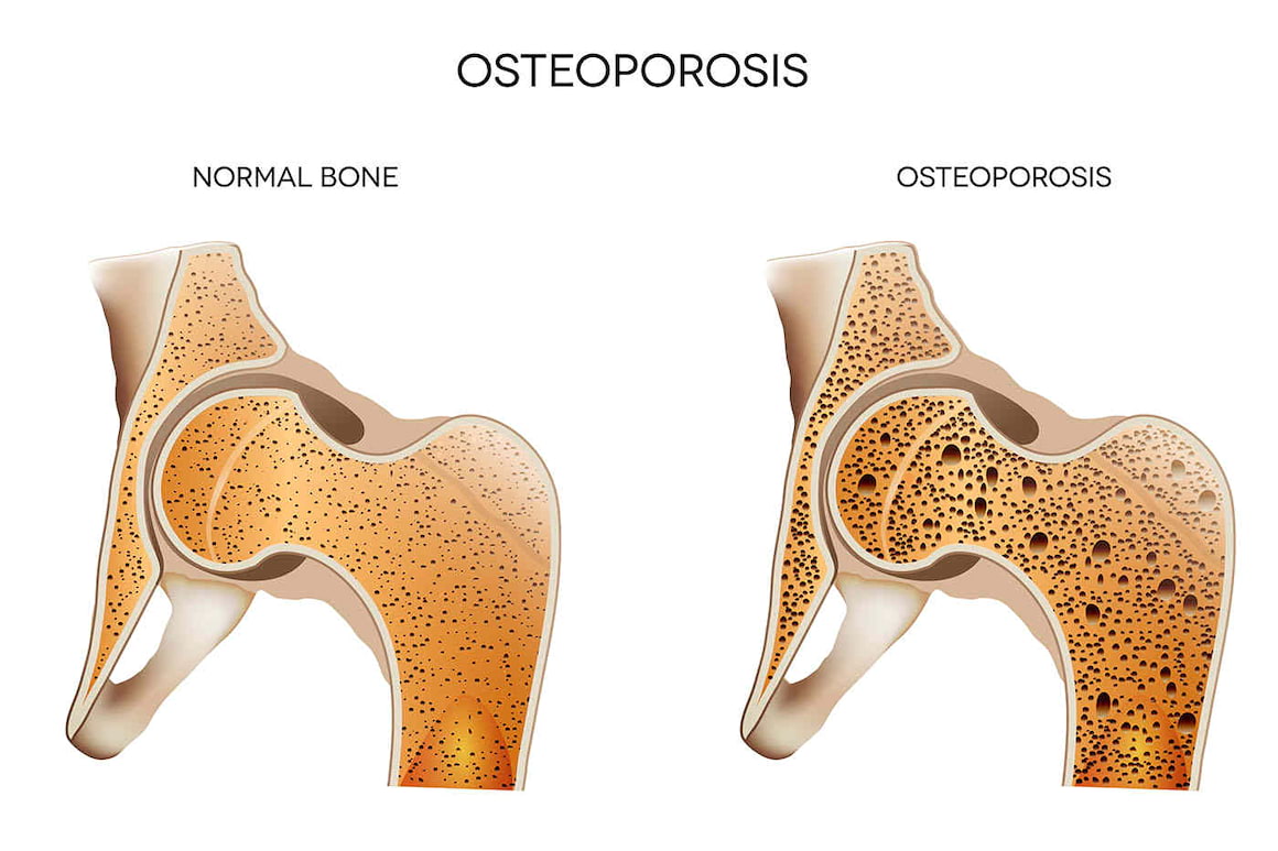Osteoporoza crește riscul de boli de inimă la femei (studiu)