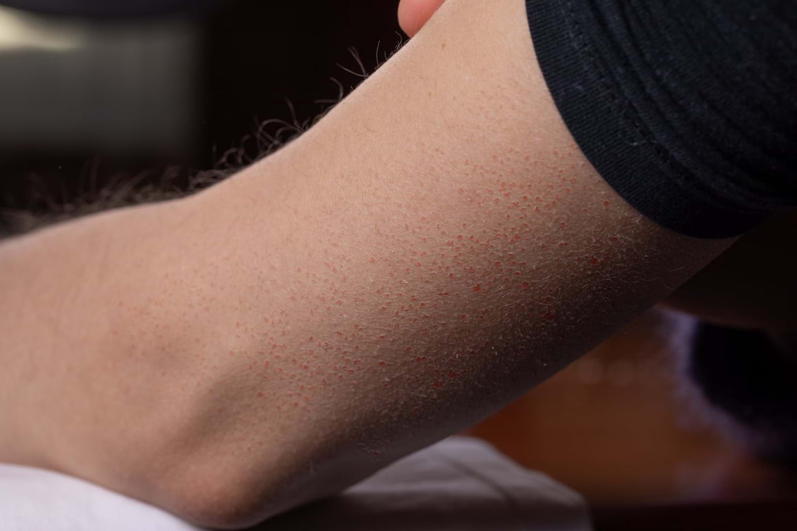 Keratoza foliculară sau pilară: cauze, simptome, remedii