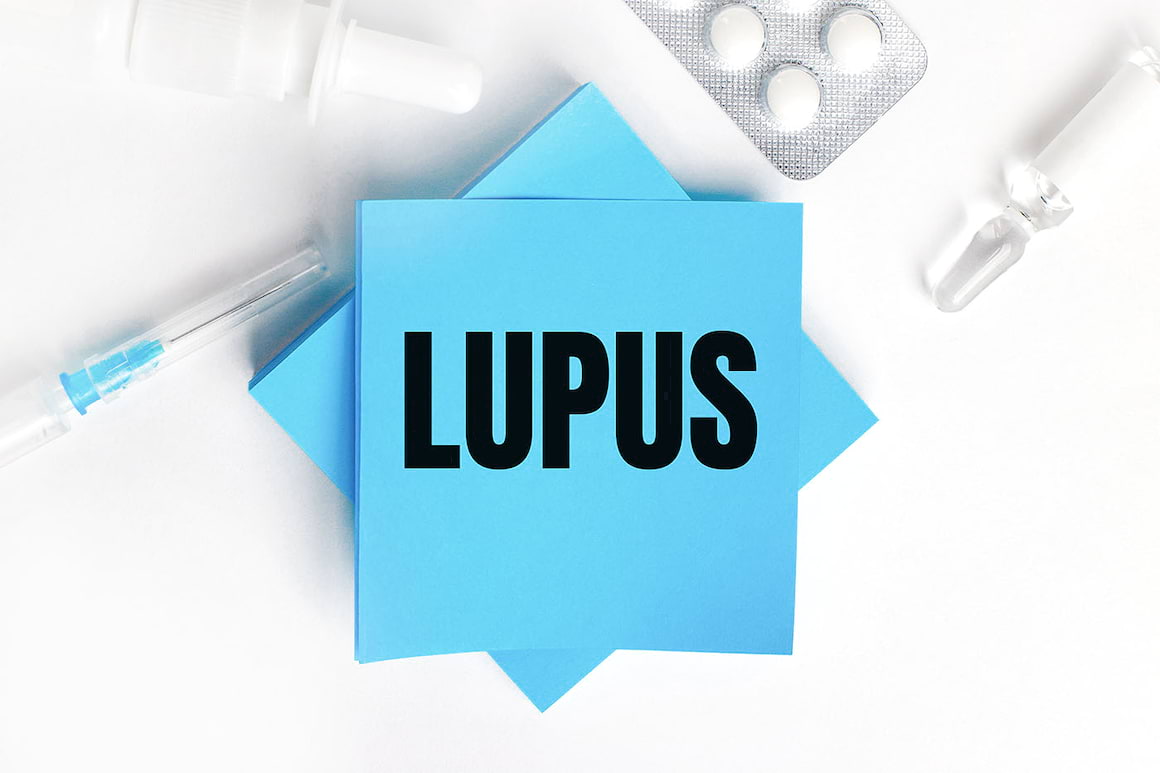 Carența de vitamina D modifică metabolismul pacienților cu lupus [studiu]