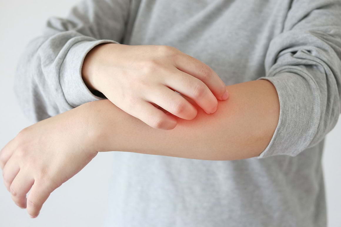 Mâncărimile asociate cu eczema, influențate de factorii de mediu [studiu]