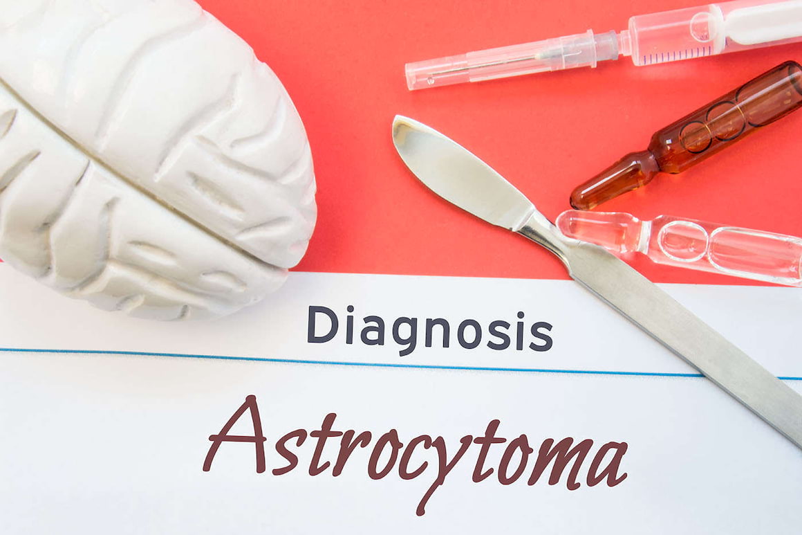 Astrocitomul: cauze, simptome, tratament