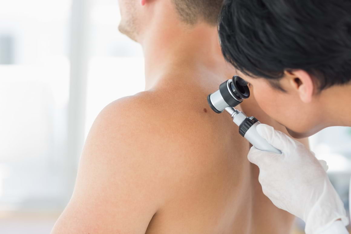Dermatofibrosarcom protuberans: simptome, cauze, tratament