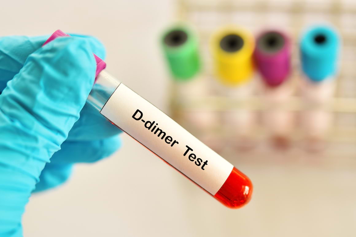 Măsurarea D-dimerilor, un indicator important al trombozei