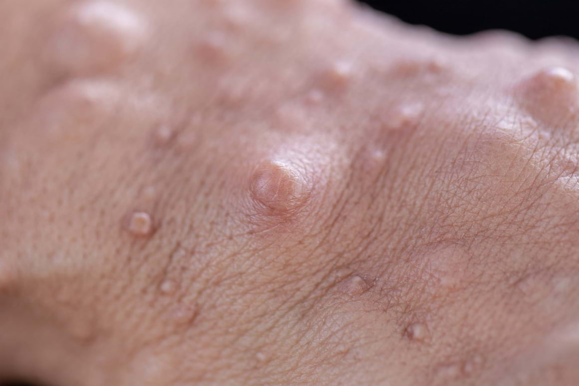 Neurofibromatoza sau boala petelor “café-o-lait”