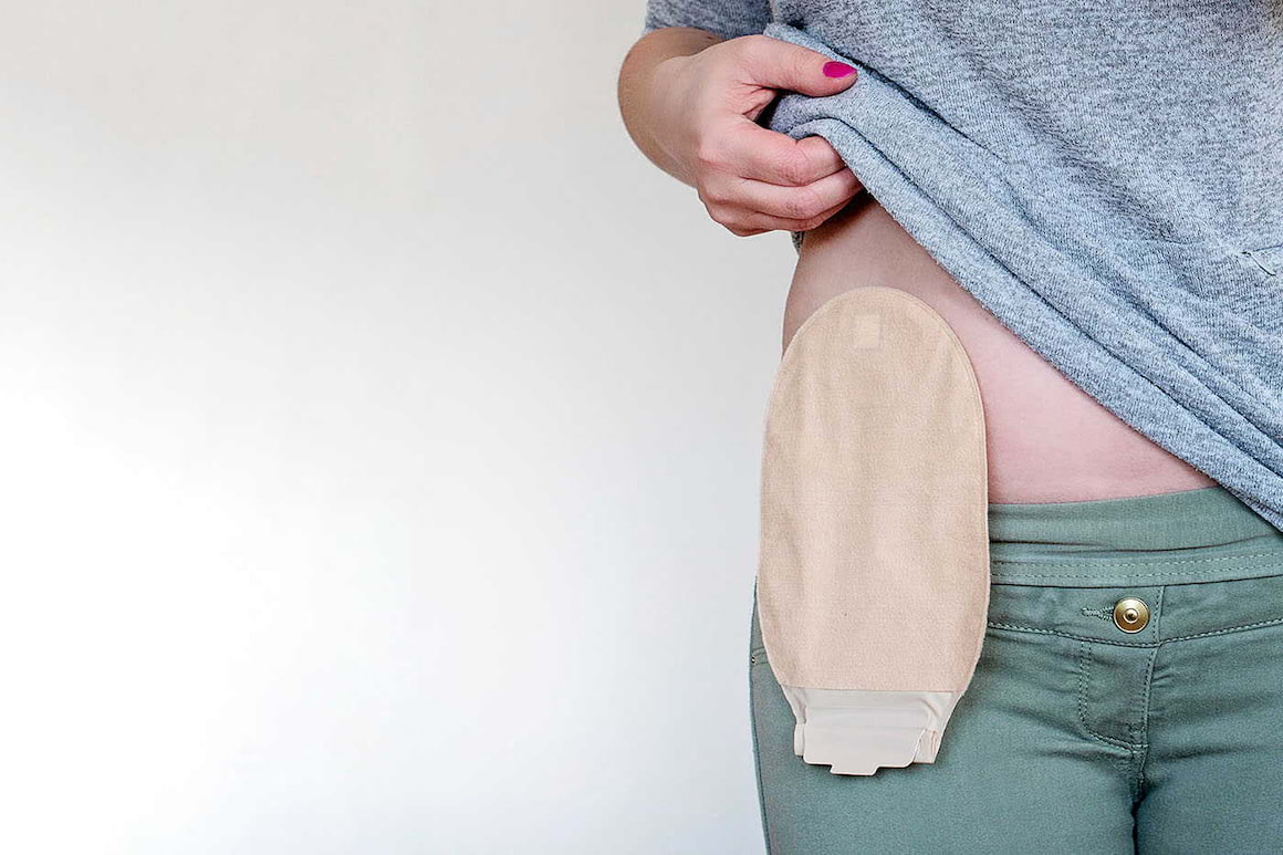 Ileostomia și colostomia: ce diferențe sunt între cele două intervenții?